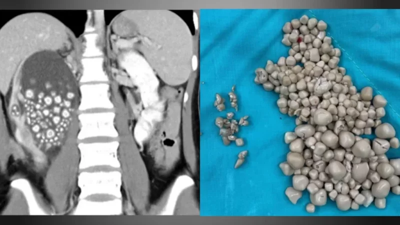 Médicos retiram 300 pedras do rim de mulher que não tomava água