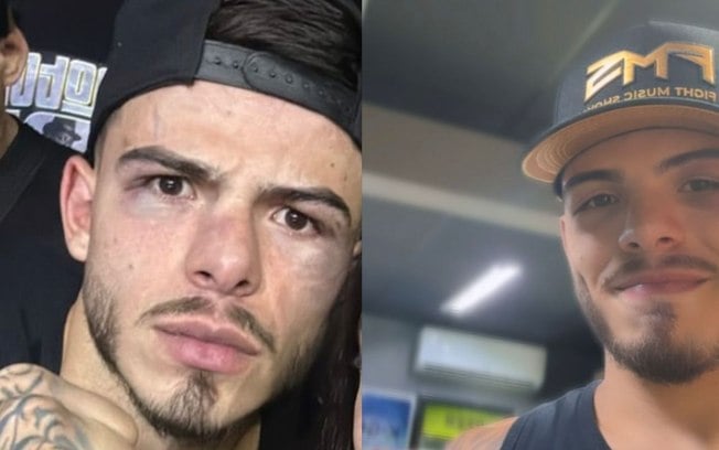 Thomaz Costa surge com olho roxo após luta contra Luiz Mesquita; fotos Thomaz Costa surge com olho roxo após luta contra Luiz Mesquita; fotos
