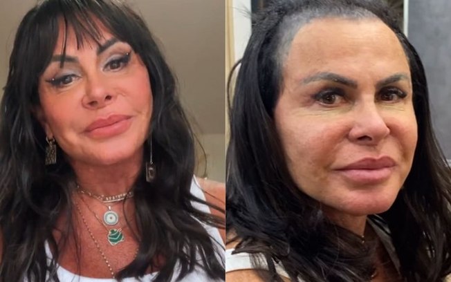 Gretchen aparece calva e dispara: ‘Perdi todo o cabelo’