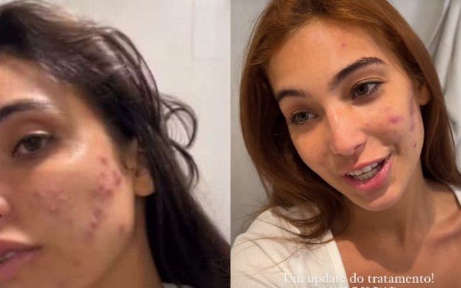Vanessa Lopes desabafa sobre tratamento contra acne: ‘Não aguento’ Vanessa Lopes desabafa sobre tratamento contra acne: ‘Não aguento’